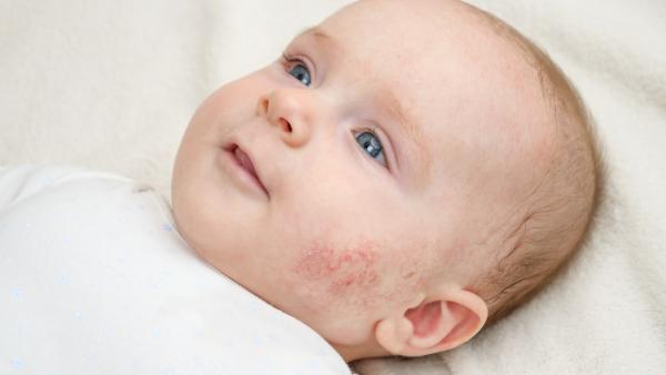 Dermatită atopică: Ce poți și ce NU poți face dacă al tău copil suferă de această afecțiune cu origine necunoscută