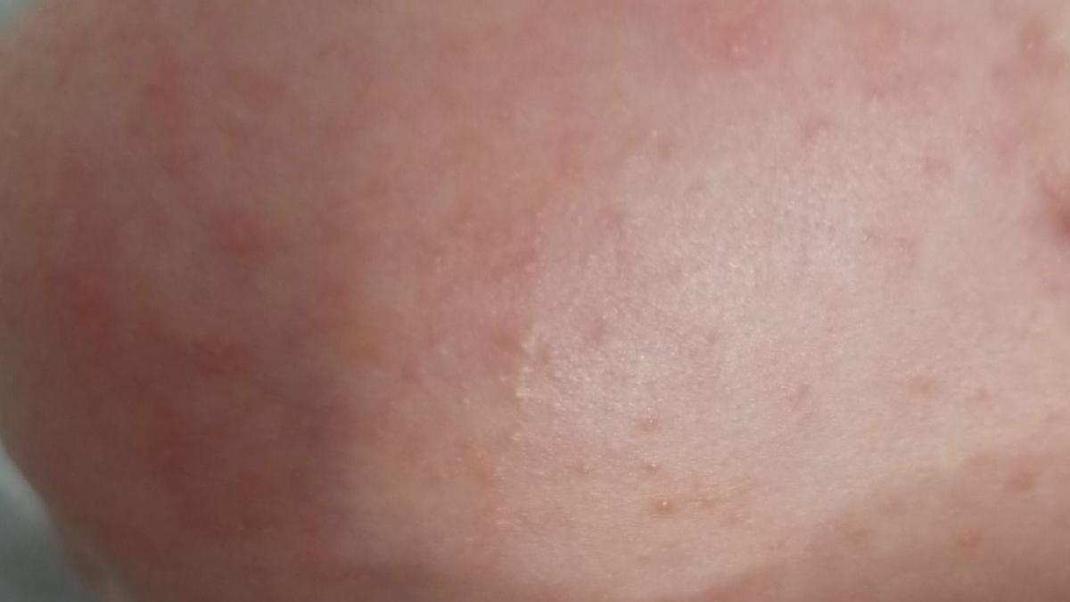 bebelus-acnee_11215900