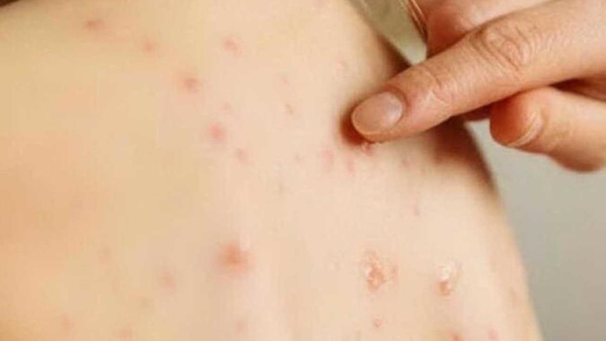 eruptii-cutanate-la-copii_33896000