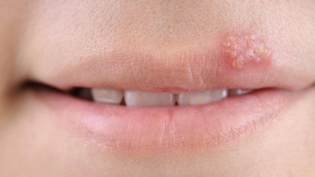herpes-labial_00699400