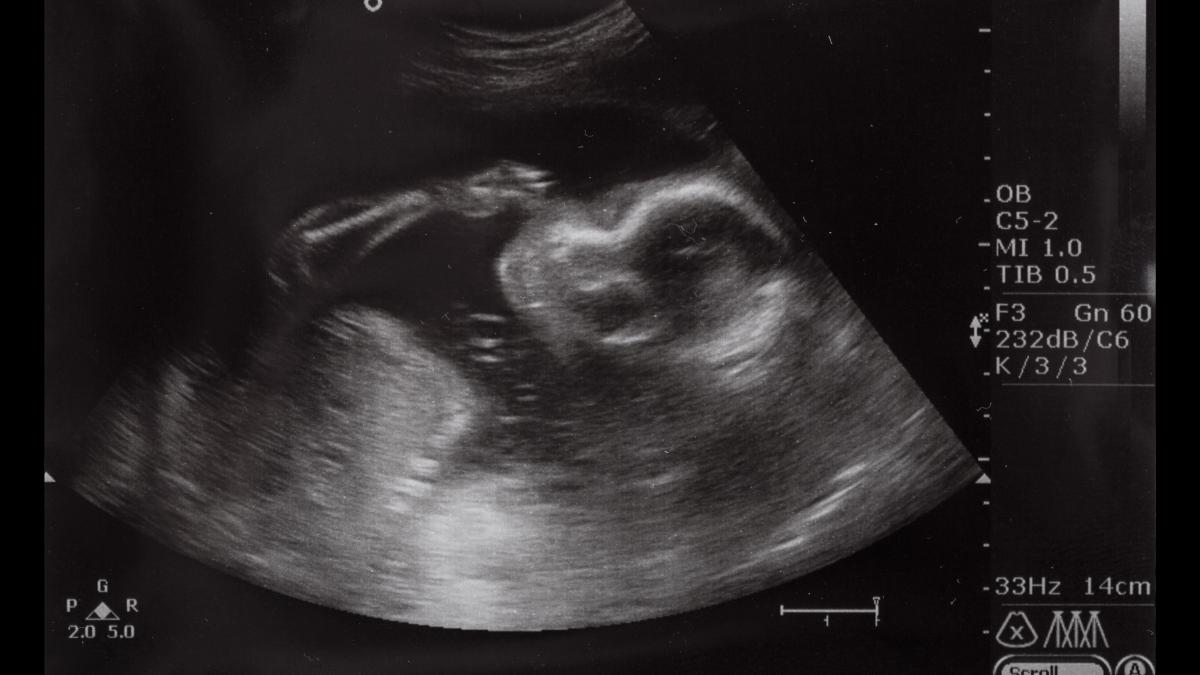 iti-face-parul-sa-se-ridice-in-cap--ecografia-unui-copil-cu-tulburare-din-spectrul-alcoolismului-fetal--un-avertisment-clar-pentru-toti-parintii--foto-1_52296400