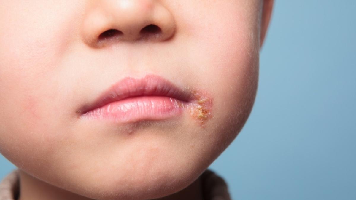 herpes-labial_34420000