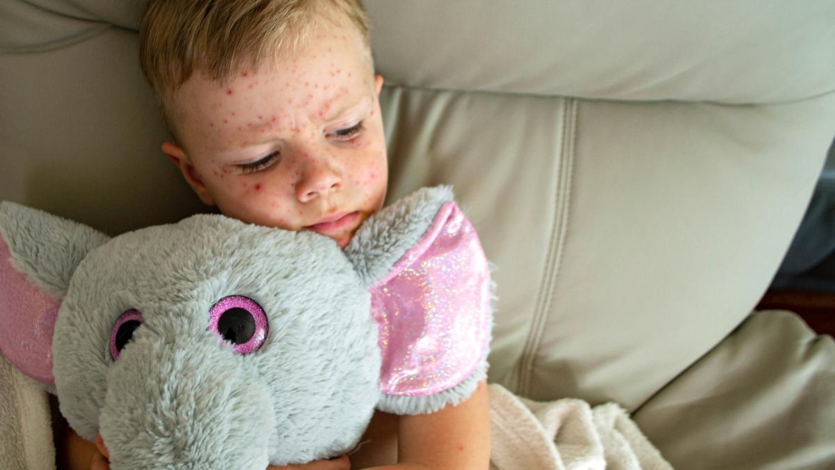 creste-alarmant-numarul-cazurilor-de-rujeola-in-romania--dr--adrian-marinescu-o-situatie-fara-precedent--pot-fi-complicatii-pulmonare--neurologice_06825200