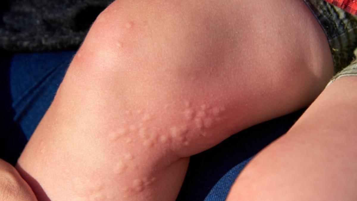 intepatura-urzica-youtube-captura_79950600