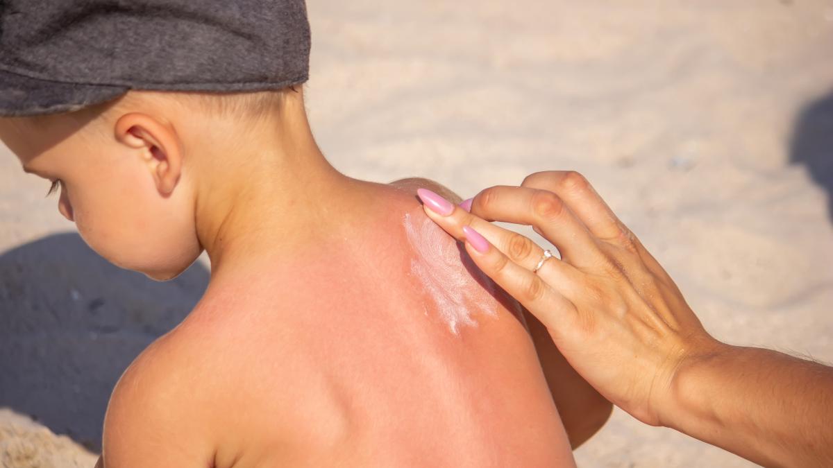 ce-sa-faci-daca-al-tau-copil-este-ars-de-soare-un-medic-pediatru-ofera-cele-mai-bune-sfaturi-pentru-parinti_82354500