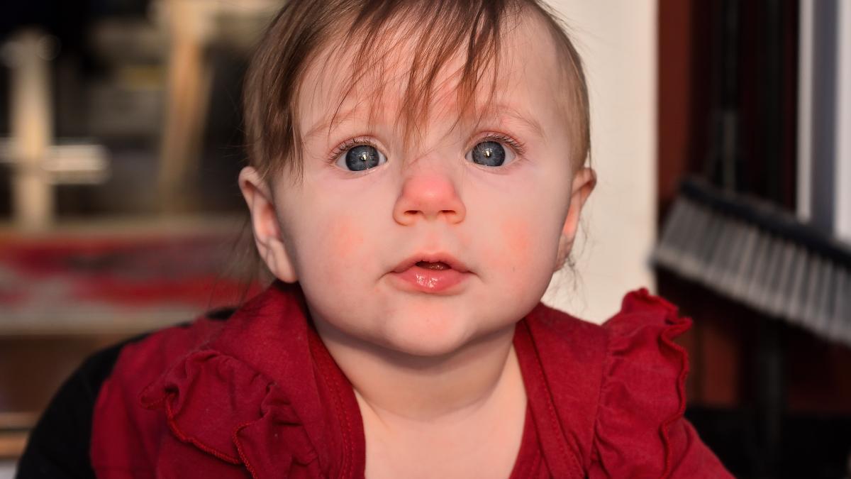 ce-este-boala-obrajilor-palmuiti-si-cum-o-recunosti_24933200