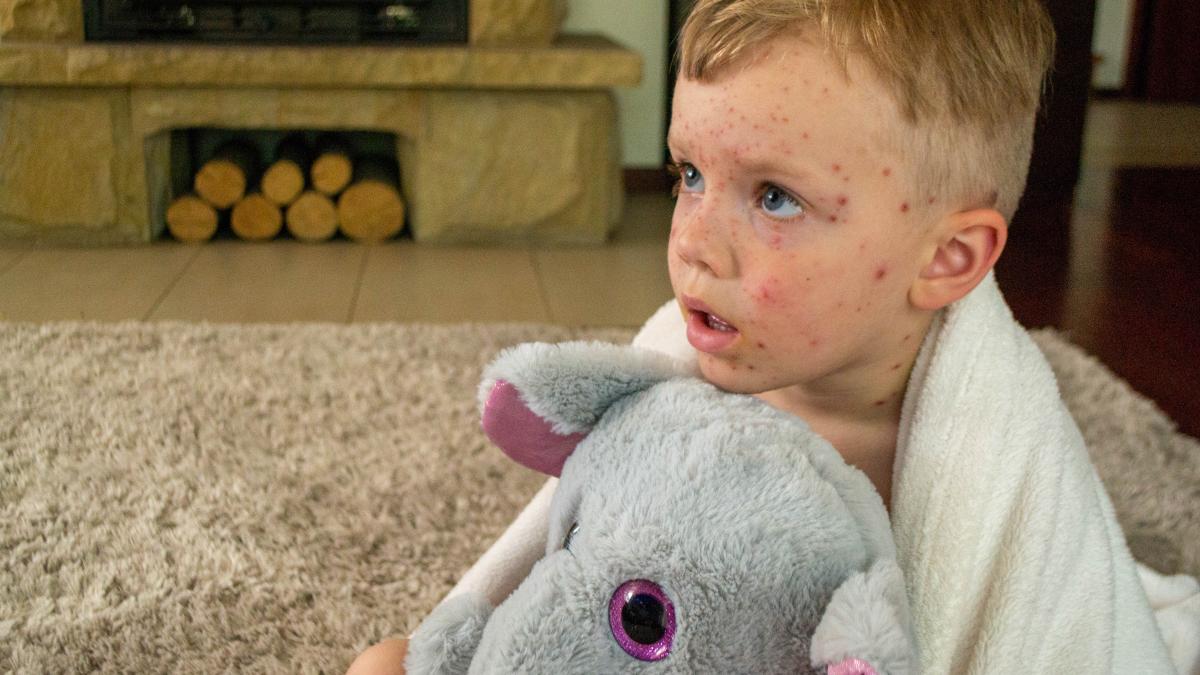 varicela-la-copii-multi-inca-spun-mai-bine-o-face-acum-cat-e-mic-dr-raluca-ghionaru-explica-tot-ce-trebuie-sa-stie-parintii-nu-e-o-boala-usoara-poate-sa-duca-la-complicatii-2_72486500