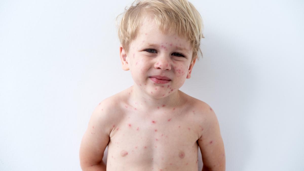 varicela-la-bebelusi-si-copiisimptome--preventie-si-semnale-de-alarma_25343200