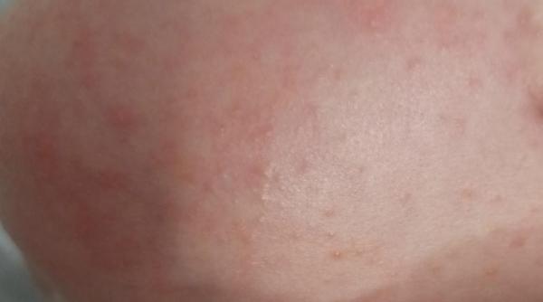 Ce sunt brobonelele mici care apar pe fața și corpul bebelușilor în jurul vârstei de o lună