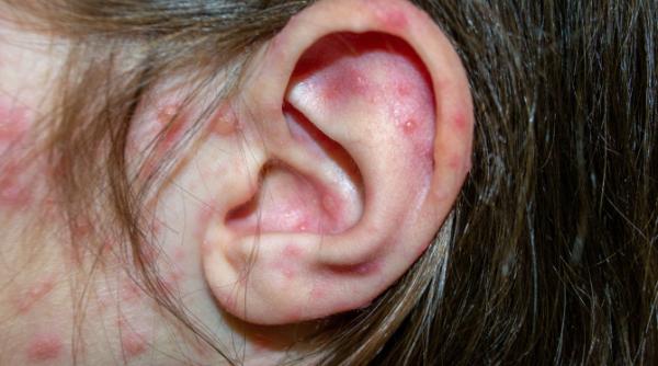 Ce sunt bolile copilăriei. Iată cele mai frecvente boli ale copilăriei