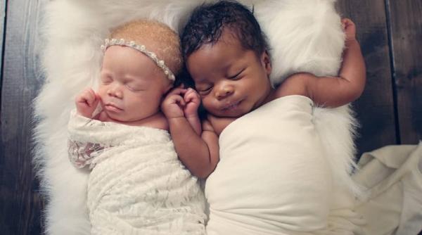 Cum a ajuns o mamă să aibă gemeni de culori diferite: Unul alb și celalalt mulatru. Povestea emoționantă a unui eveniment rar