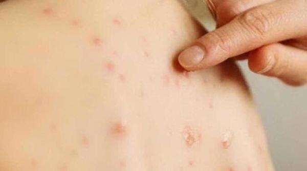 Erupție cutanată la copii: Cauzele unei erupții cutanate subite cu sau fără mâncărime. Ce să faci, când să-ți faci griji