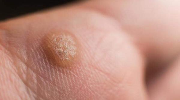 Negi la copii: de ce apar și cum să îi tratăm corespunzător