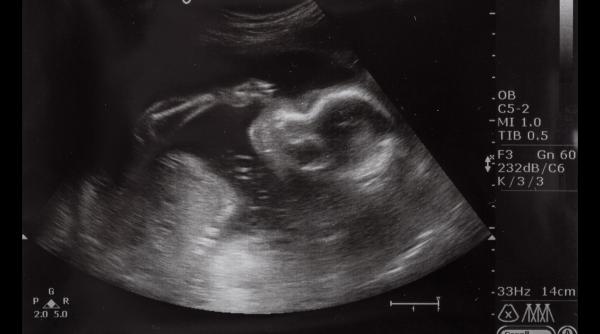 „Îți face părul să se ridice în cap”. Ecografia unui copil cu tulburare din spectrul alcoolismului fetal, un avertisment clar pentru toți părinții / FOTO