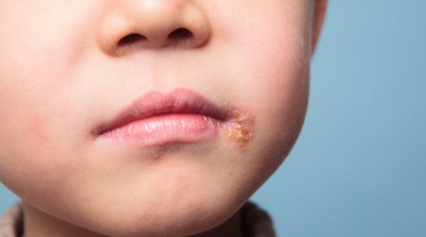 Herpes labial la copii, de la simptome la remedii