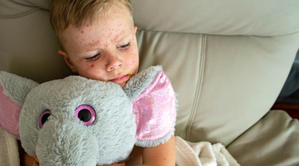 Crește alarmant numărul cazurilor de rujeolă în România. Dr. Adrian Marinescu: „O situație fără precedent. Pot fi complicații pulmonare, neurologice!”