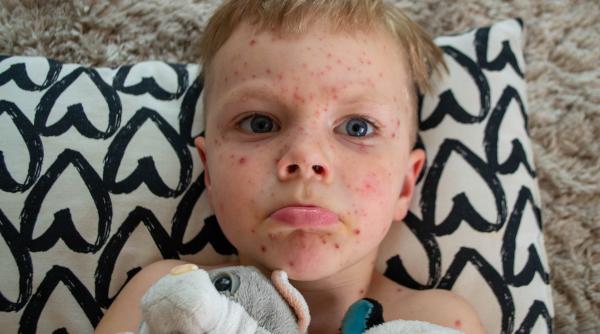 Varicela la copii. Care sunt simptomele