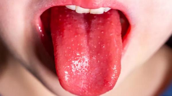 Apare o boală veche și îngrijorătoare: Sindromul „Limbă de căpșuni”