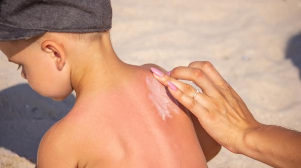 Ce să faci dacă al tău copil este ars de soare? Un medic pediatru oferă cele mai bune sfaturi pentru părinți!