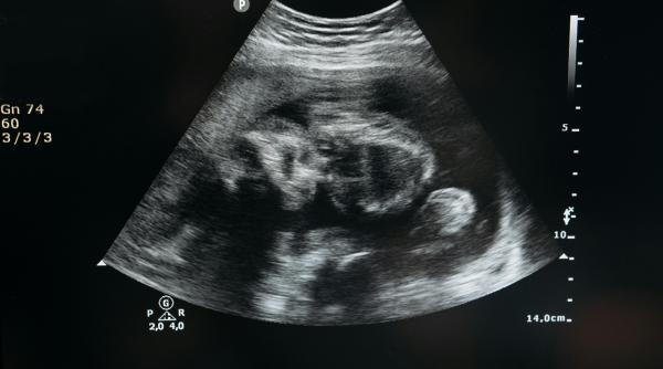 Simptomele sarcinii gemelare: care sunt acestea?