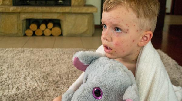 Varicela la copii. Mulți încă spun: „Mai bine o face acum, cât e mic”. Dr. Raluca Ghionaru explică tot ce trebuie să știe părinții: „Nu e o boală ușoară. Poate să ducă la complicații!” / VIDEO