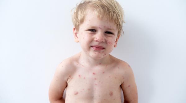 Varicela la bebeluși și copii: simptome, prevenție și semnale de alarmă